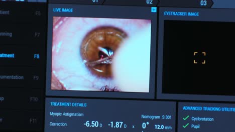 ophthalmic surgery. view on the screen of medical monitor in operating room. lasik