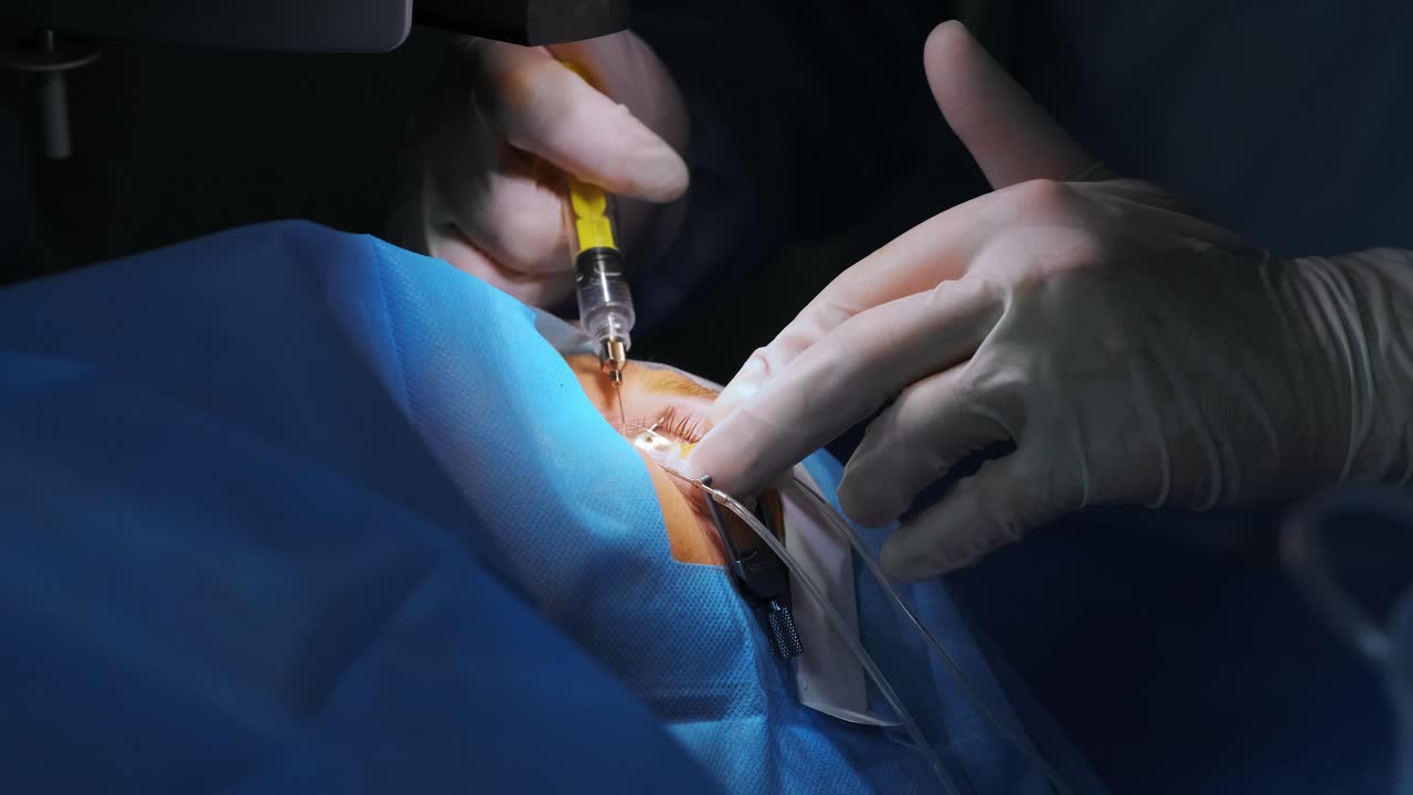 коррекция зрения лазером. пациент и команда хирургов в операционной во время офтальмологической хирургии. спекулум веков. лечение лазиком. пациент под стерильным покрытием