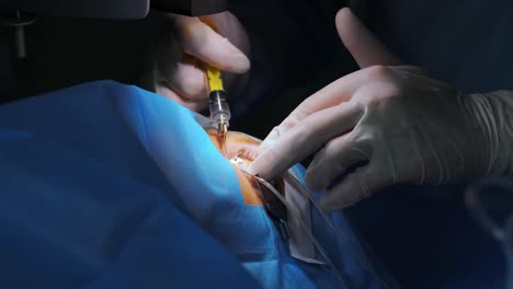 corrección de la visión con láser. un paciente y un equipo de cirujanos en la sala de operaciones durante una cirugía oftalmológica. especulo del párpado. tratamiento de lasik. paciente bajo una cubierta estéril