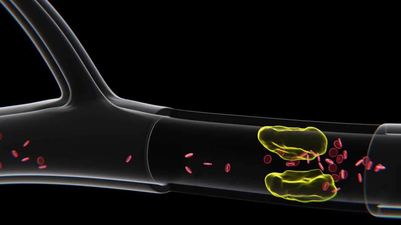 Arterienverschluss Visualisierungsvideo in 4K | Röntgenvideo eines Arterienverschlusses