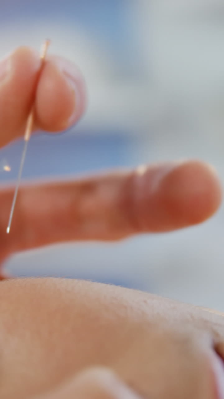 mujer que recibe tratamiento de acupuntura en una clínica