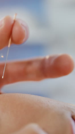 woman receiving acupuncture treatment in clinic