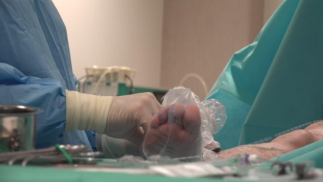 la ablación endovenosa con láser es una terapia mínimamente invasiva muy eficaz y de uso común para controlar las várices en las piernas.