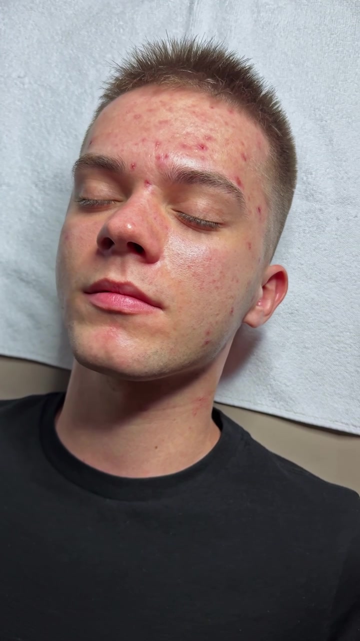 Giovane uomo riceve un trattamento per la cura della pelle per l'acne in una clinica nel pomeriggio, con un focus sulla cura e il miglioramento del viso