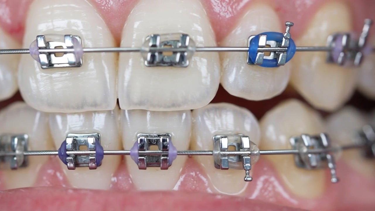 Primo piano estremo di apparecchio ortodontico in metallo e arco su denti molto nitidi con elastici blu