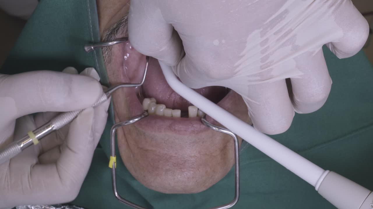 dentist performs a tooth extraction on a patient, using dental tools for precision