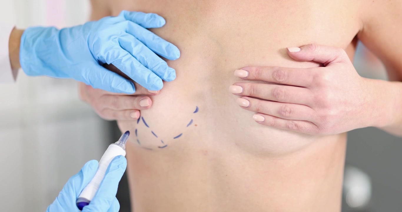 Il medico segna i segmenti sul paziente per il posizionamento dell'impianto.