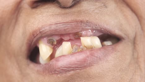 dental issues in an elderly person