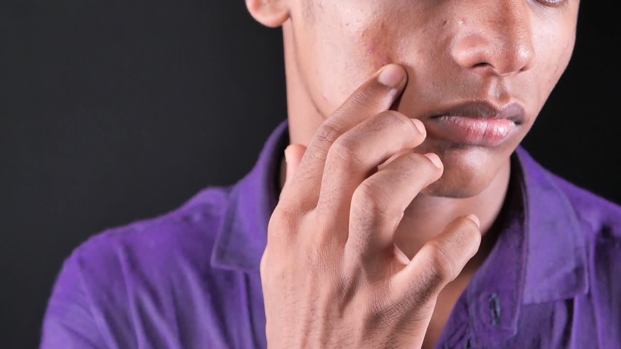primer plano de la cara de un joven con acné