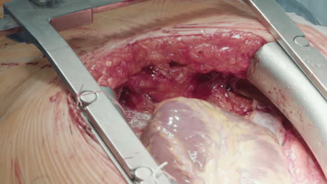 chest cavity opened with retractors. rib spreaders for effective surgery open access to heart during coronary artery bypass graft in hospital