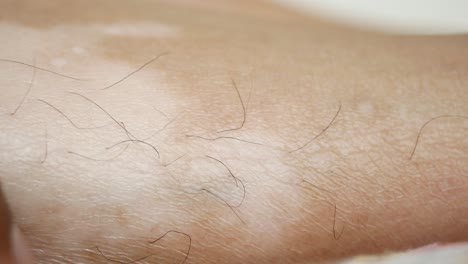 close-up of vitiligo on a person's arm