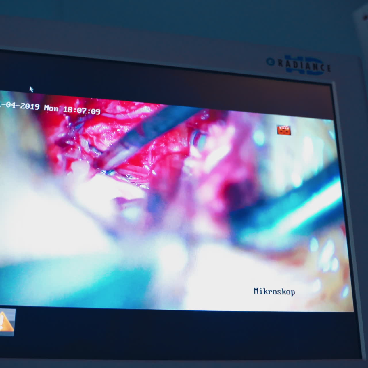 Close-up shoot of operation on the monitor. Operating process of internal organs with medical instruments on a display. New technologies in surgery.