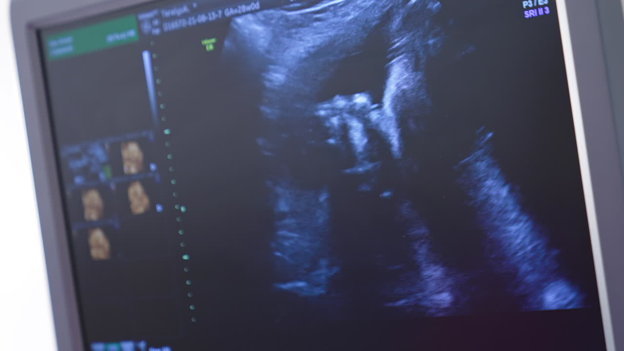Baby in mother's womb is moving during sonography. Ultrasonography screen.
