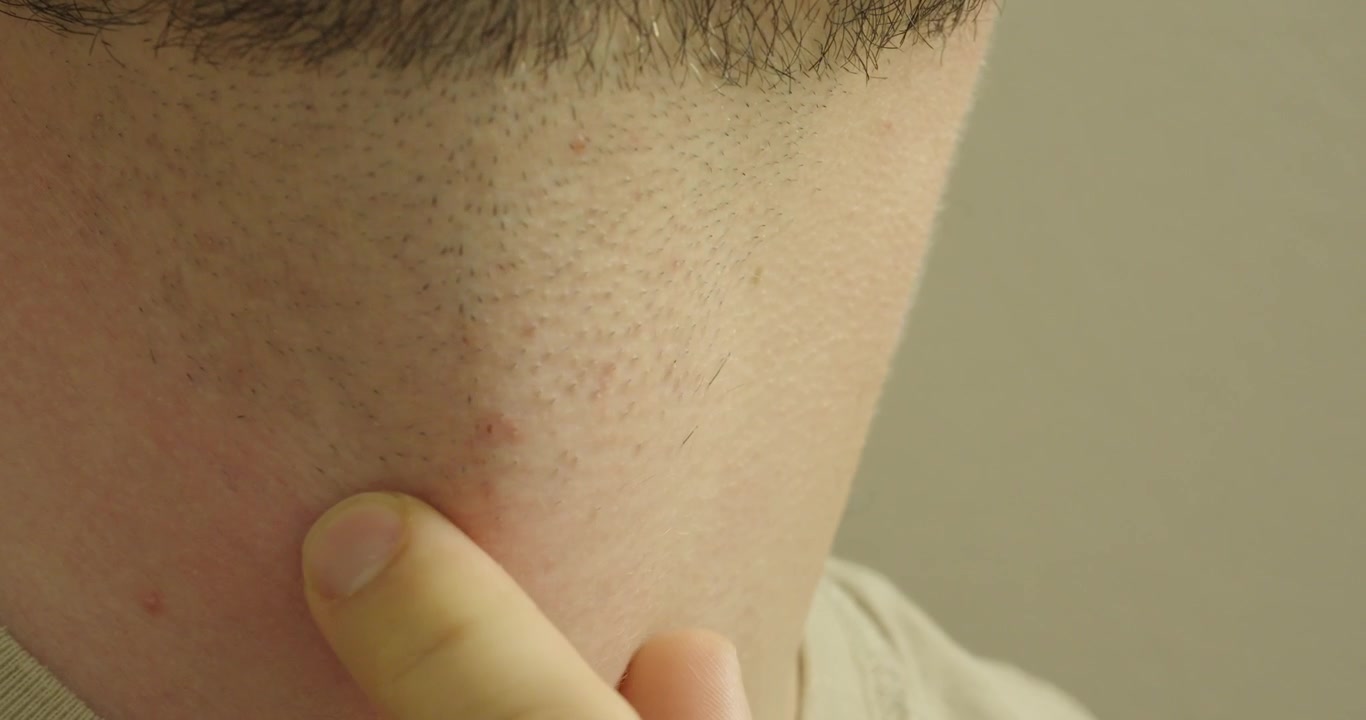 Primo piano di un uomo che tocca la pelle irritata sul collo dopo la rasatura. Concetto di bruciore da rasoio, eruzione cutanea da rasatura, irritazione della pelle, pelle sensibile e cura della persona.