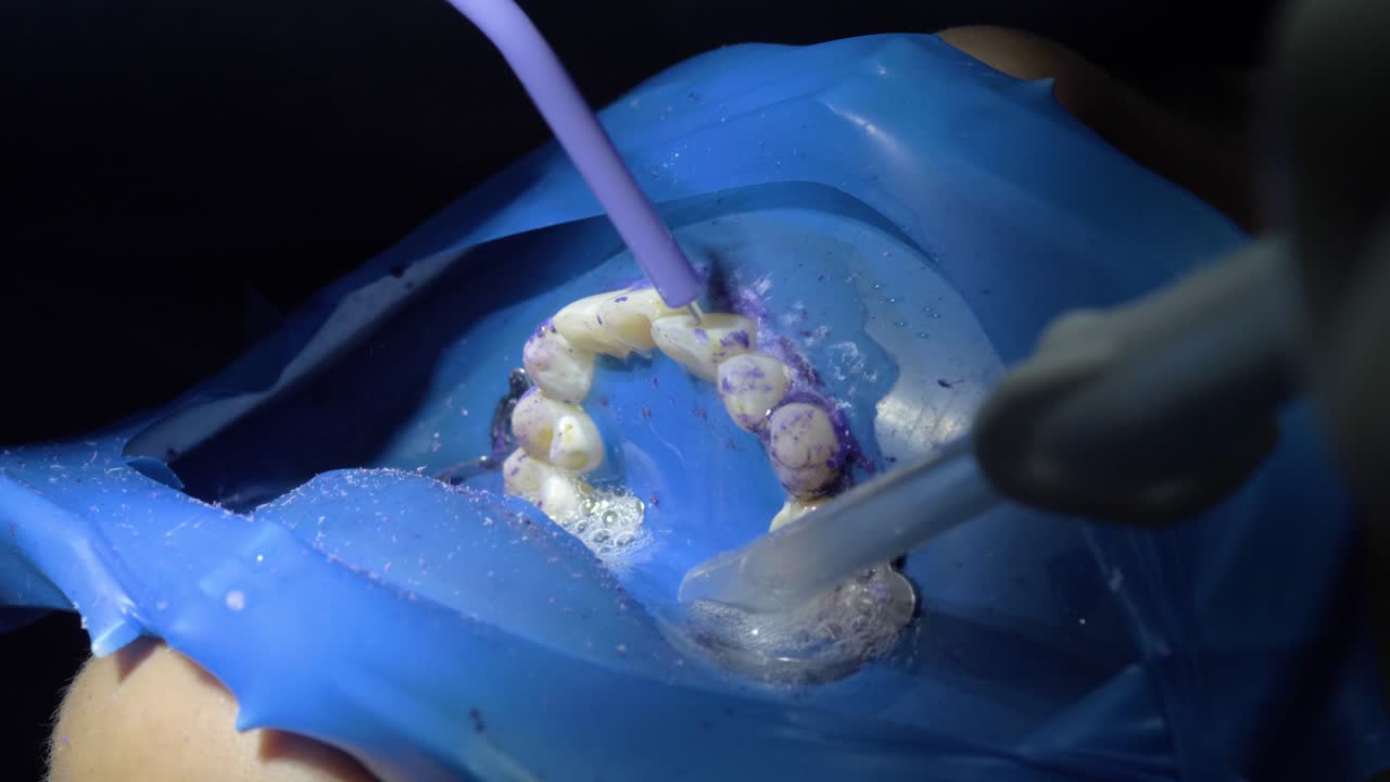 enjuague y aspiración de agua durante la limpieza dental