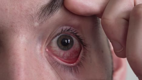 Rotes-Auge-Mit-Blutigen-Adern,-Nahaufnahme