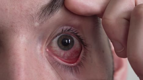 ojos rojos con venas sangrientas, primer plano