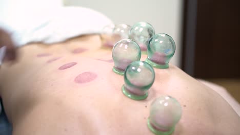 cupping therapy session