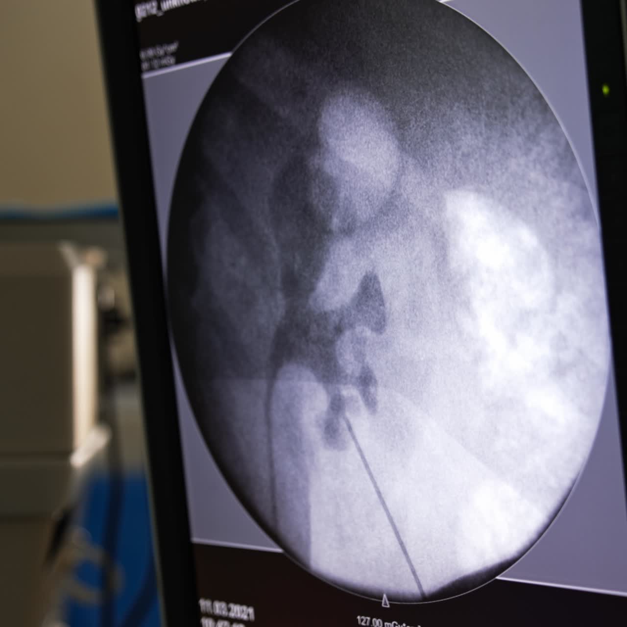 Screen showing the ultrasound picture of an operated organ. Close up. Equipment of a modern surgery room