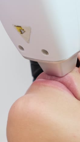 laser hair removal procedure on face