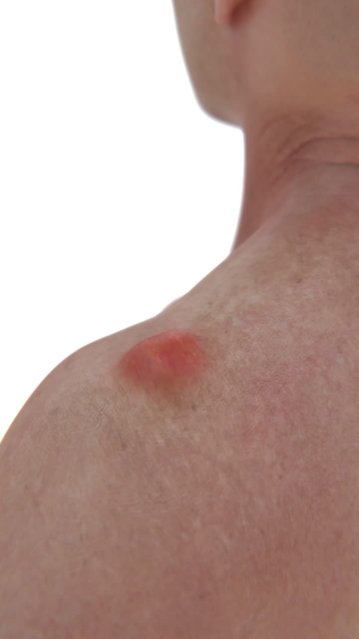 A Man With Lipoma In 4K | Lipomas on body video | Video for Cosmetic Surgeons