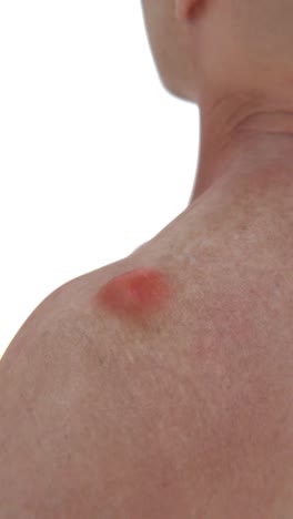 a man with lipoma in 4k | lipomas on body video | video for cosmetic surgeons