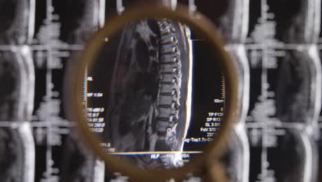 Resonancia-Magnética-De-Fondo-De-Columna-Lumbar,-Tomografía-Por-Resonancia-Magnética.-El-Médico-Examina-La-Resonancia-Magnética-De-La-Columna-Lumbar-Con-Discos-Comprimidos-De-La-Columna-Y-Los-Nervios.