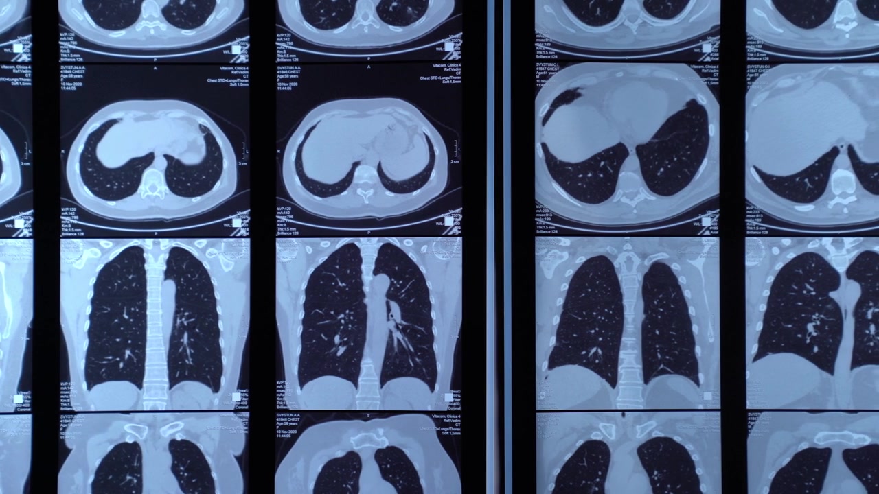 Diverse scansioni TC di polmoni umani su display medico