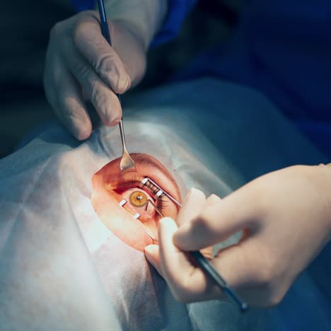 cataract surgery close up