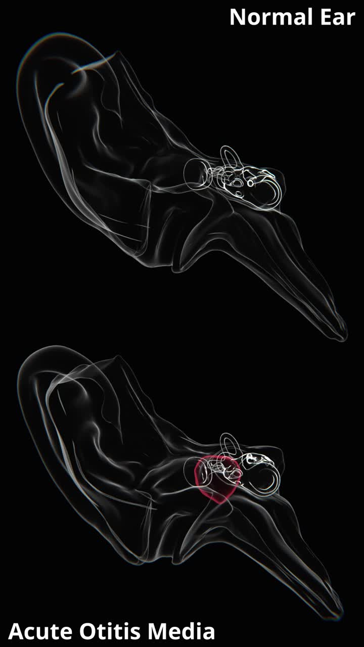 Xray Video of Normal ear vs Acute otitis media | Normal ear vs Acute otitis medias Xray video in vertical | Normal ear vs Acute otitis media in 4K Video