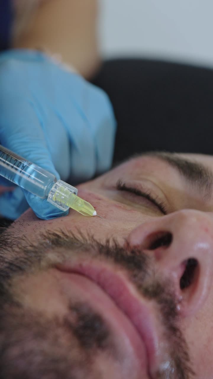Questo primo piano cattura un medico specializzato in medicina estetica, mentre esegue una precisa iniezione intradermica di polinucleotidi su un paziente di sesso maschile.
