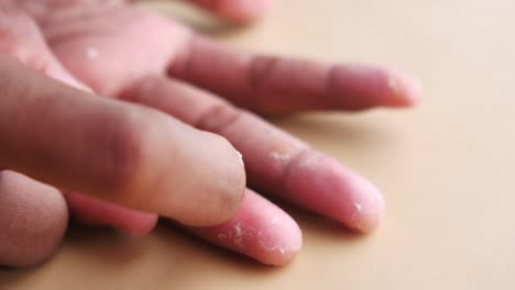 close-up image of dry, peeling skin on a hand