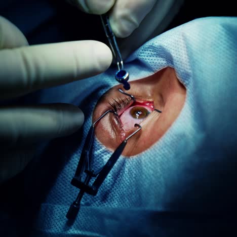 treatment of eye. operation in eye to a patient. professional doctor performs ophthalmological procedure on eye with special medical instrument. close-up