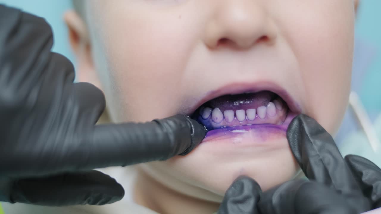 Caries Detector Dye. Diagnosis of caries in a child