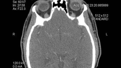 axial computed tomography: ct scan layers through head into chest