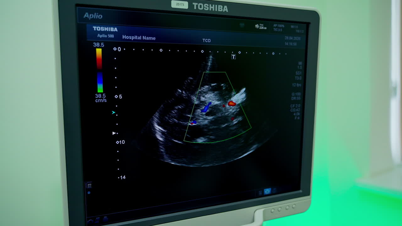 Ultrasound on screen of a computer. Medical monitor shows sick organ of a patient during ultrasound research. Close-up.