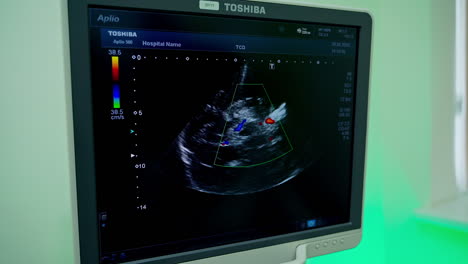 ultrasound on screen of a computer. medical monitor shows sick organ of a patient during ultrasound research. close-up.
