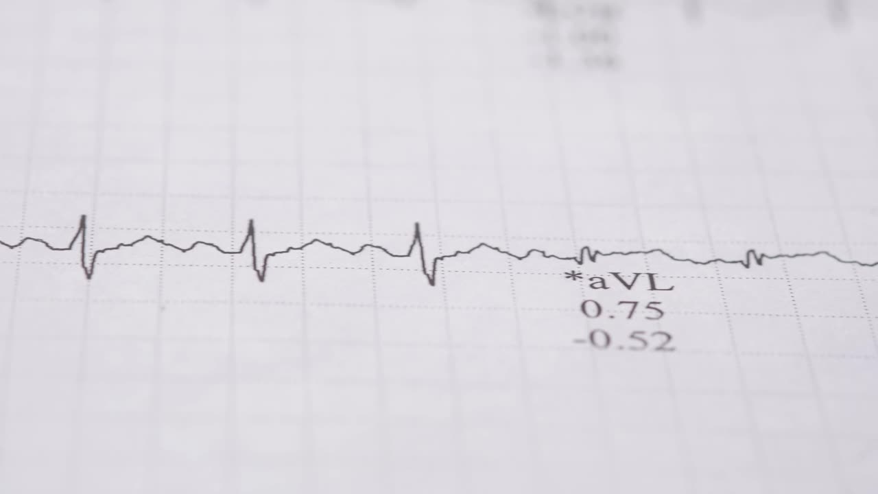 심전도 (ecg) 판독