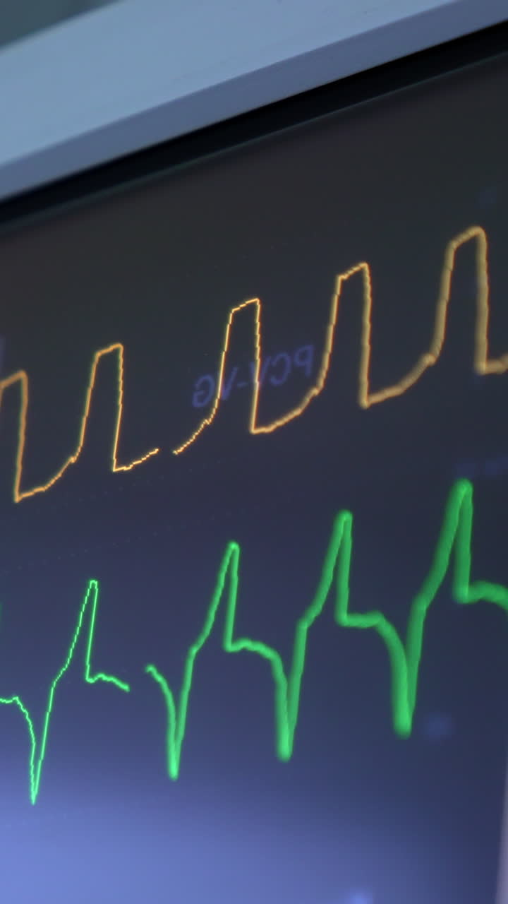 Green and orange curves running on the black screen of medical equipment. Close up. Life signs op the patient at surgery. Vertical video