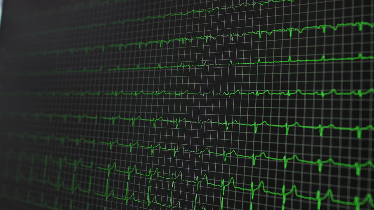 Hjertemonitorering, hjertemonitor, elektrokardiografi, problemfri animation