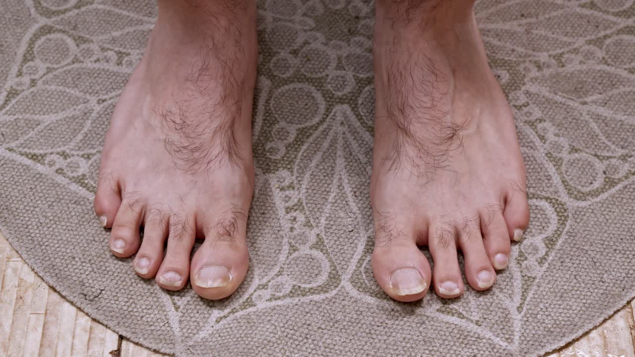 Close-up of a man's hairy feet with damaged and uncared for toenails standing on a patterned rug. View from a personal perspective