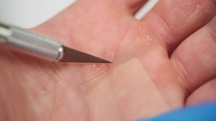 Lo scienziato di laboratorio preleva un campione della pelle screpolata del paziente.