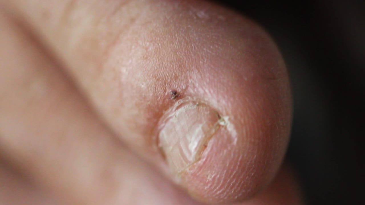 dita dei piedi brutte, primo piano delle unghie dei piedi
