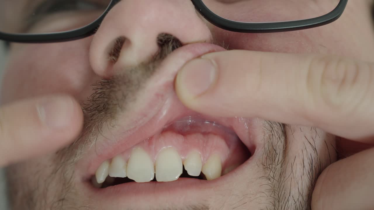 Primo piano di un uomo che tira il labbro per mostrare le gengive infiammate. Concetto di dolore alle gengive, gengivite, infiammazione dentale e problemi di salute orale.