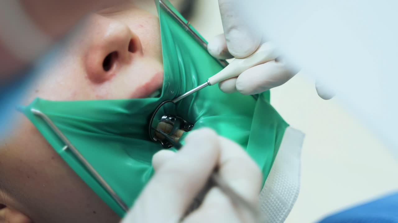 A doctor using dental tools examines a tooth of a young girl. Tooth isolated by latex green plate rubber dam. Close-up