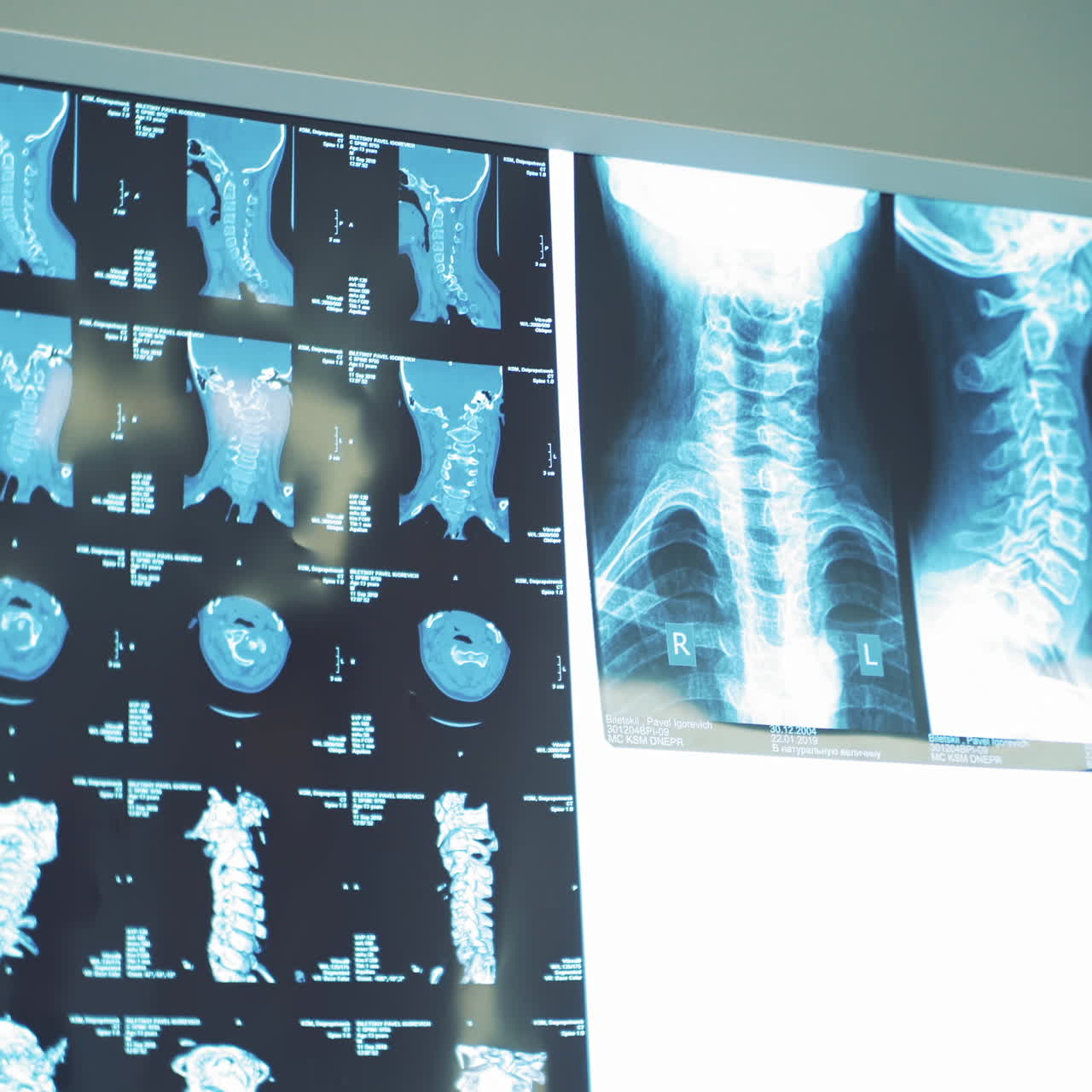 Doctor male is showing the problem area on the x-ray photograph to the woman. Spinal tomography is hanging on the white board and the doctor discussing the results.