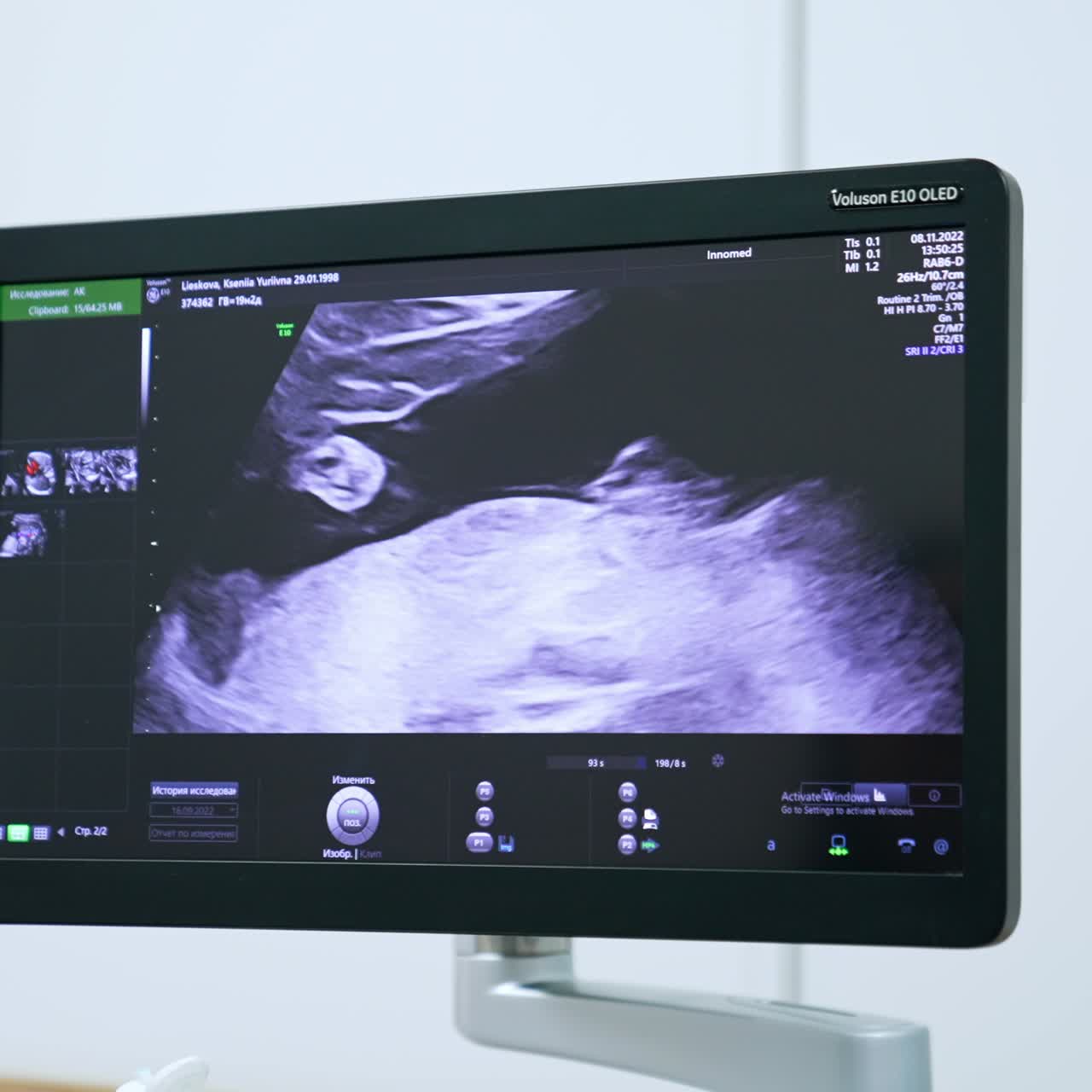 Image of intrauterine development of the baby. Ultrasound machine monitor in doctor's cabinet