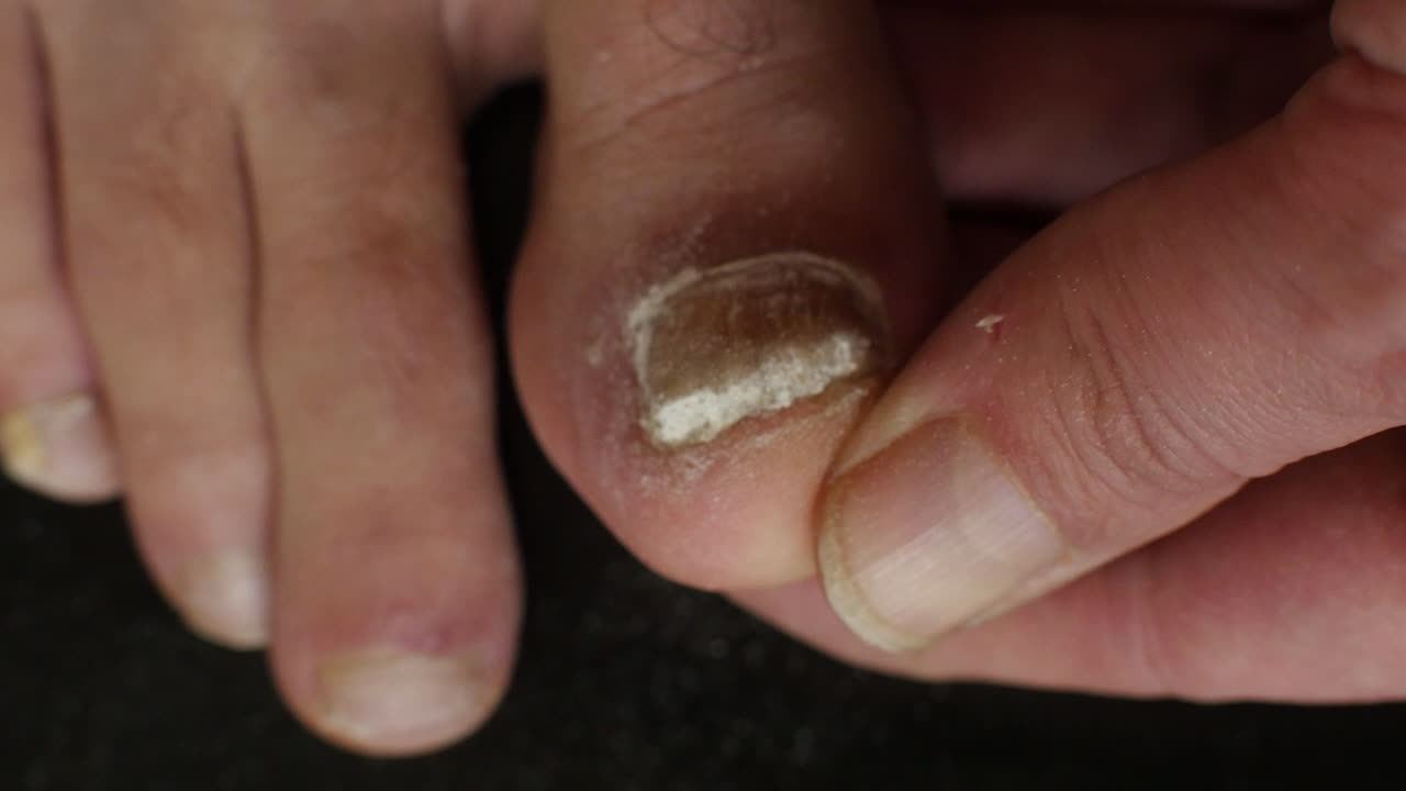 Close-up of a big toe fungal infection being filed down with a small nail file
