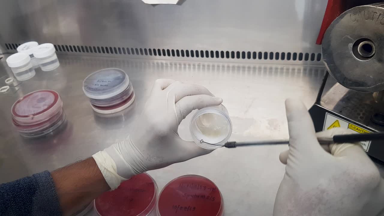 recogida de muestras de pus de un recipiente de muestras mediante un bucle de inoculación