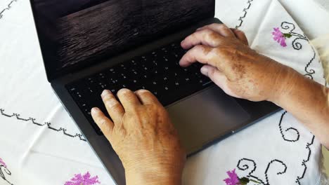 mujer con vitíligo en las manos trabajando en la computadora
